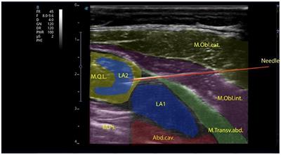 Elevated serum TLR4 level as a potential marker for postsurgical chronic pain in pediatric patients with different approaches to analgesia